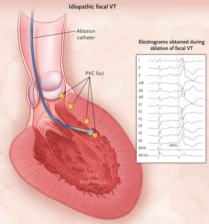 Ablación de extrasistoles ventricular