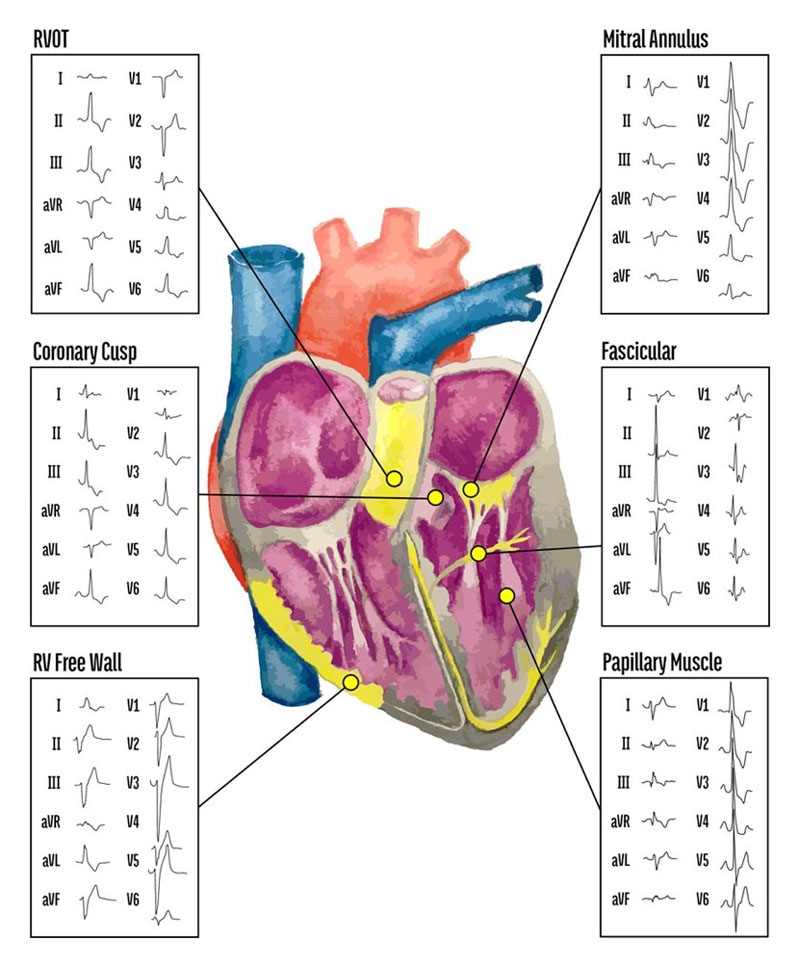 Ablación de extrasistoles ventricular