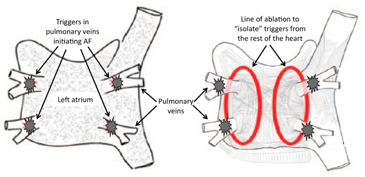 Ablación de fibrilación auricular