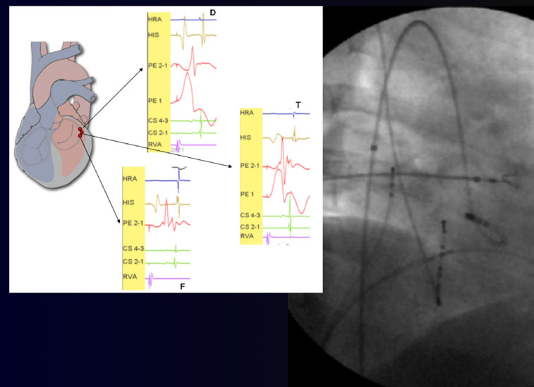 Ablación de taquicardia supraventricular congelación