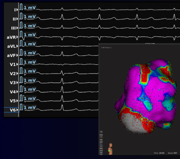 Ablación de taquicardia supraventricular electroanatómico