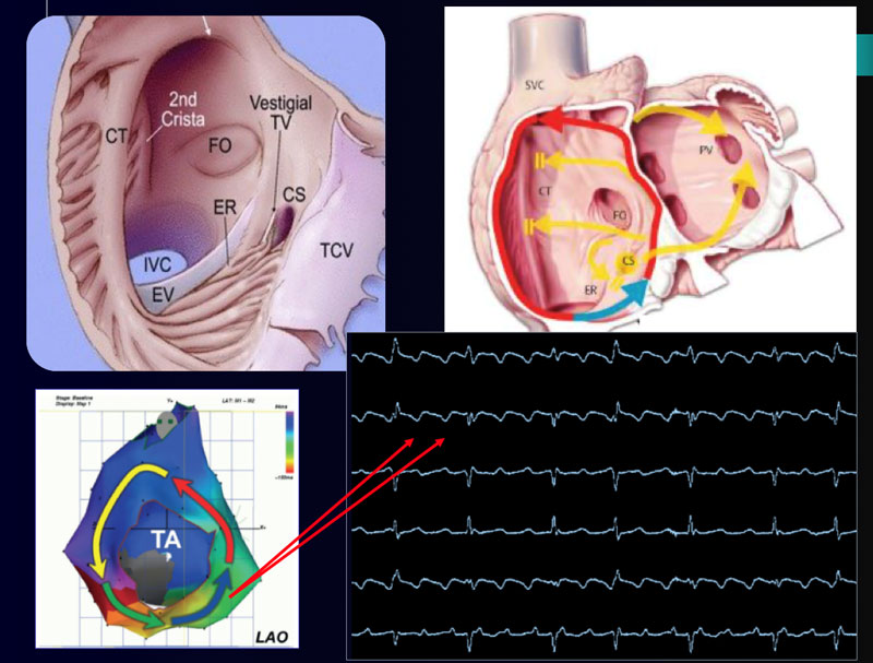 Ablación de taquicardia supraventricular monitor