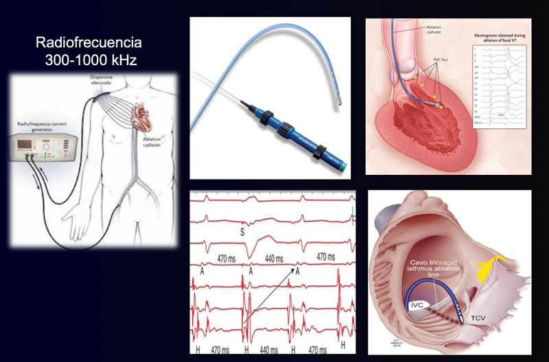 Ablación de taquicardia supraventricular radiofrecuencia