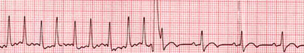 Cardioversión eléctrica pulsioximetría