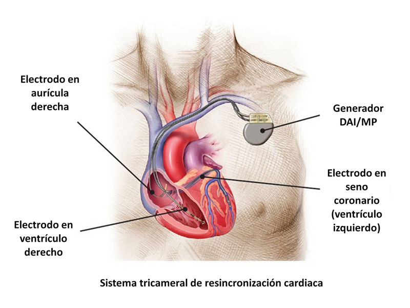 Desfibrilador